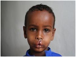 A four-year-old boy from Ethiopia, after surgery