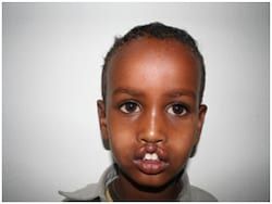 A four-year-old boy from Ethiopia, before surgery