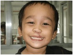 A two-year-old boy from the Philippines, after surgery